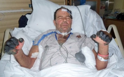 حقيقة صورة إصابة رجل حرق المصحف بمرض في يديه
