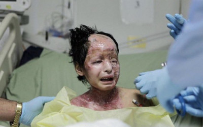 حقيقة صورة الفتاة المصابة بحروق القنبلة الفسفورية في فلسطين