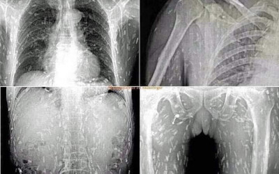 حقيقة صور الأشعة لمريض تَسبَب "السوشي" في إصابته بديدان في جميع أنحاء جسده