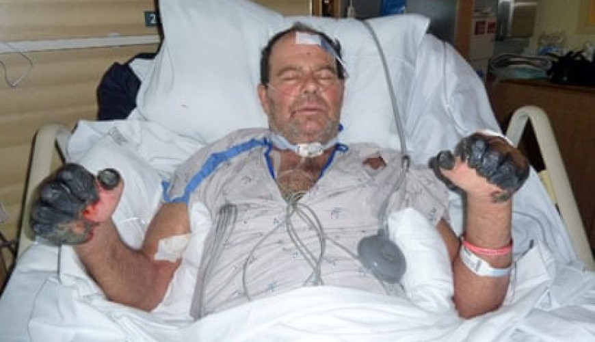 حقيقة صورة إصابة رجل حرق المصحف بمرض في يديه