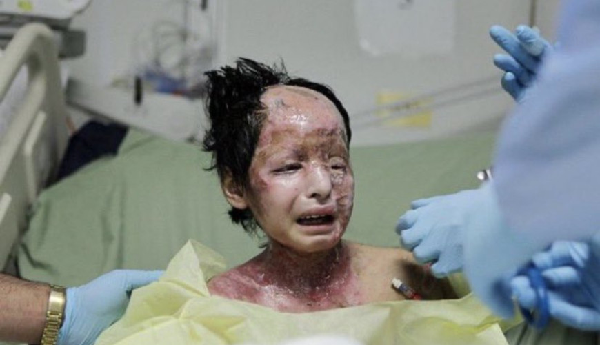 حقيقة صورة الفتاة المصابة بحروق القنبلة الفسفورية في فلسطين